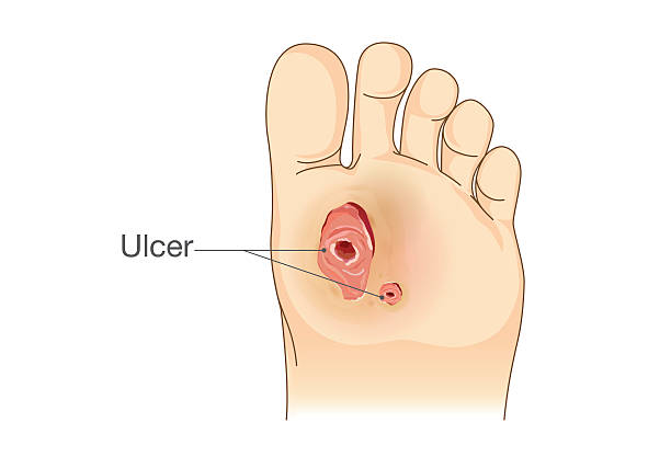 Jeevottama Health - Service - Ulcer Management