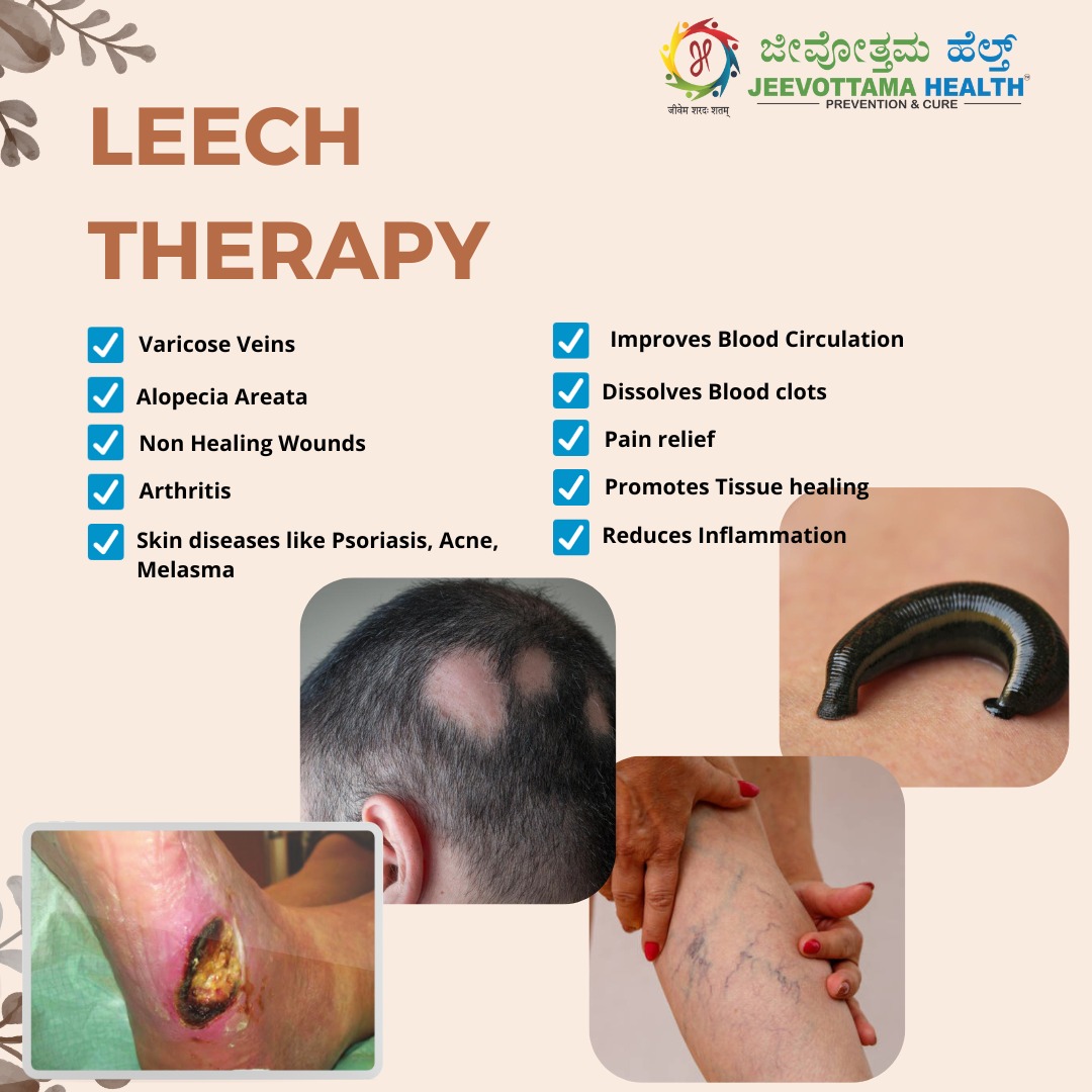Jeevottama Health - Album - Leech Therapy